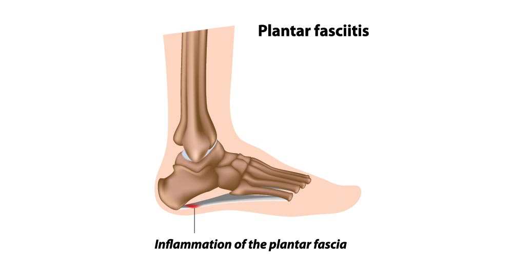 Causes, Prevention & Treatments of Plantar Fasciitis